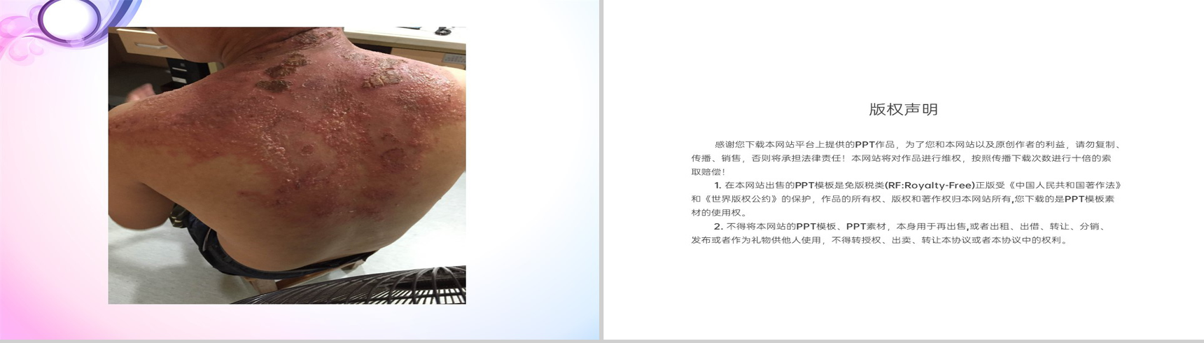 紫色简约风三伏贴技术操作规范理论基础教学PPT模板-38